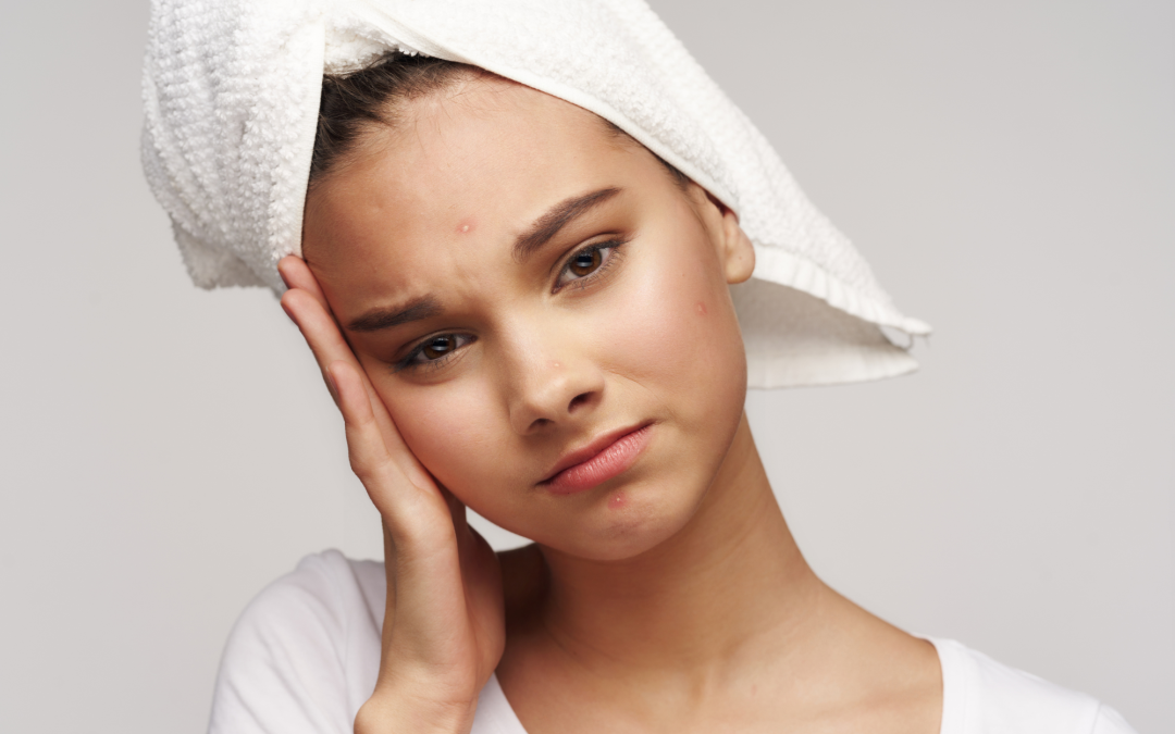 The Effective, Efficient, and Natural Ways of Treating Acne